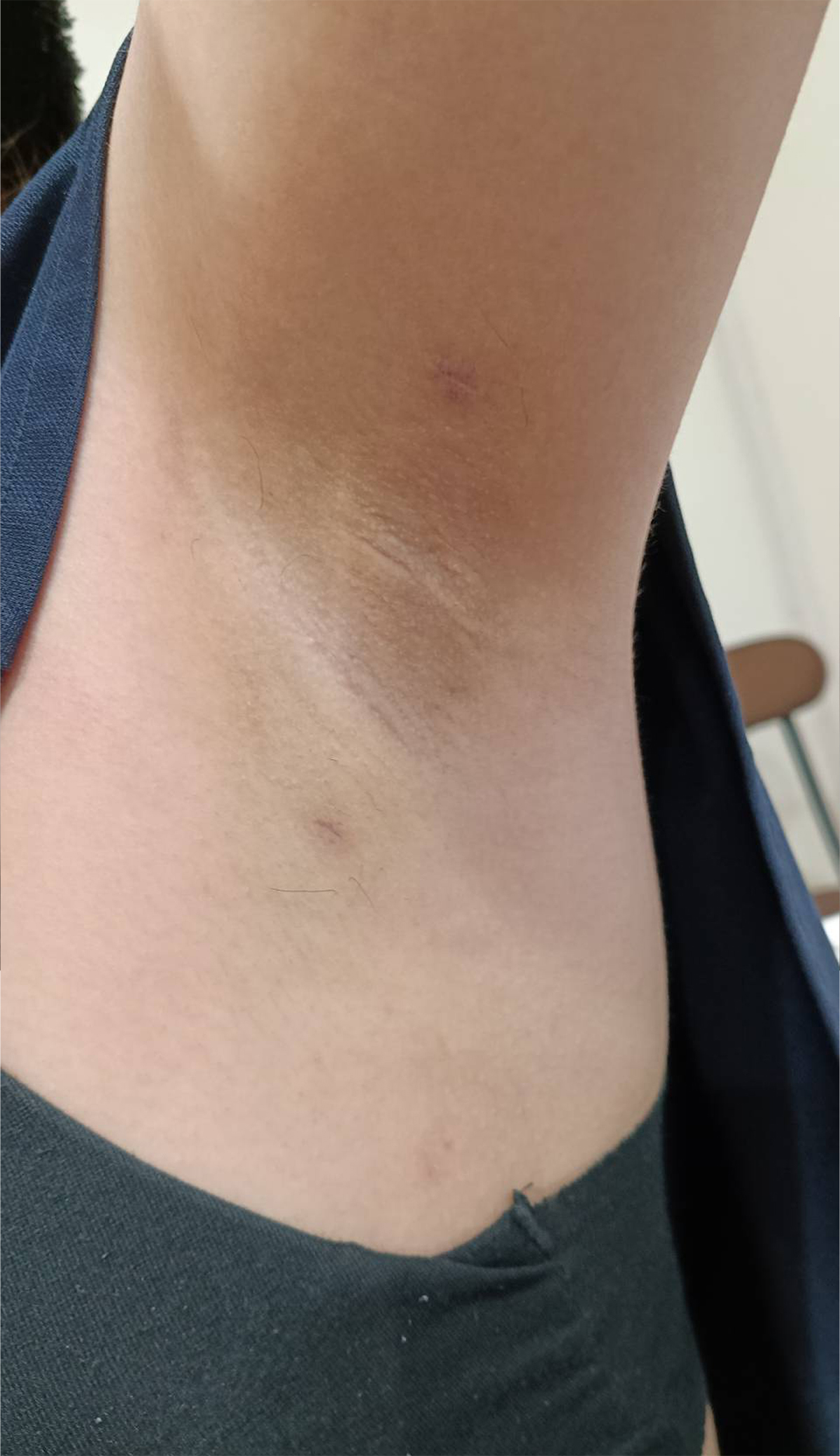 腋臭症 1年後 症例
